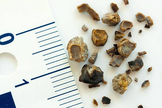 Reducing the Risk of Kidney Stone Formation Through Water Intake, Diet, and Lifestyle Changes